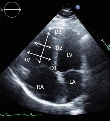 lv dilation echo|lv wall thickness echo.